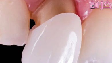 تفسير حلم خلع الأسنان