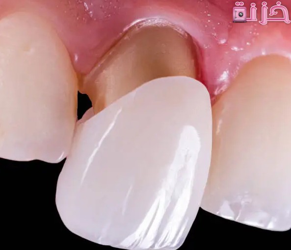 تفسير حلم خلع الأسنان