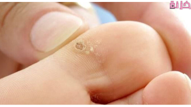 علاج عين السمكة