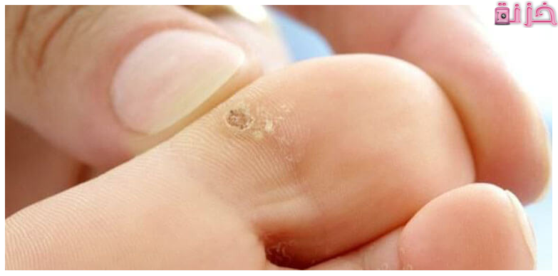 علاج عين السمكة