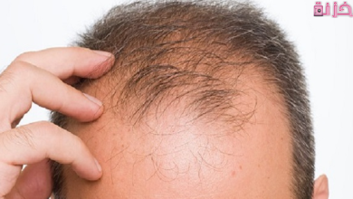 اسباب تساقط الشعر بكثرة من الجذور عند النساء والشباب