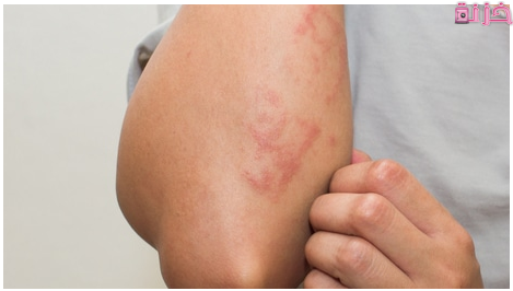 أفضل طريقة ودواء علاج الحساسية الجلدية مجرب ومضمون