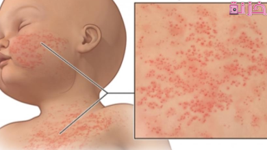 الفرق بين حمو النيل والحساسية عند الاطفال والكبار