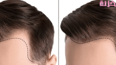 أسعار زراعة الشعر في مصر