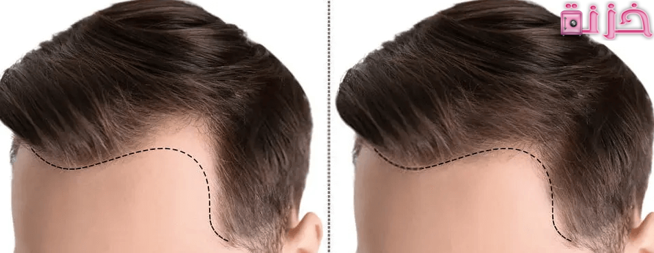 أسعار زراعة الشعر في مصر