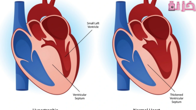 هل تضخم القلب يزول